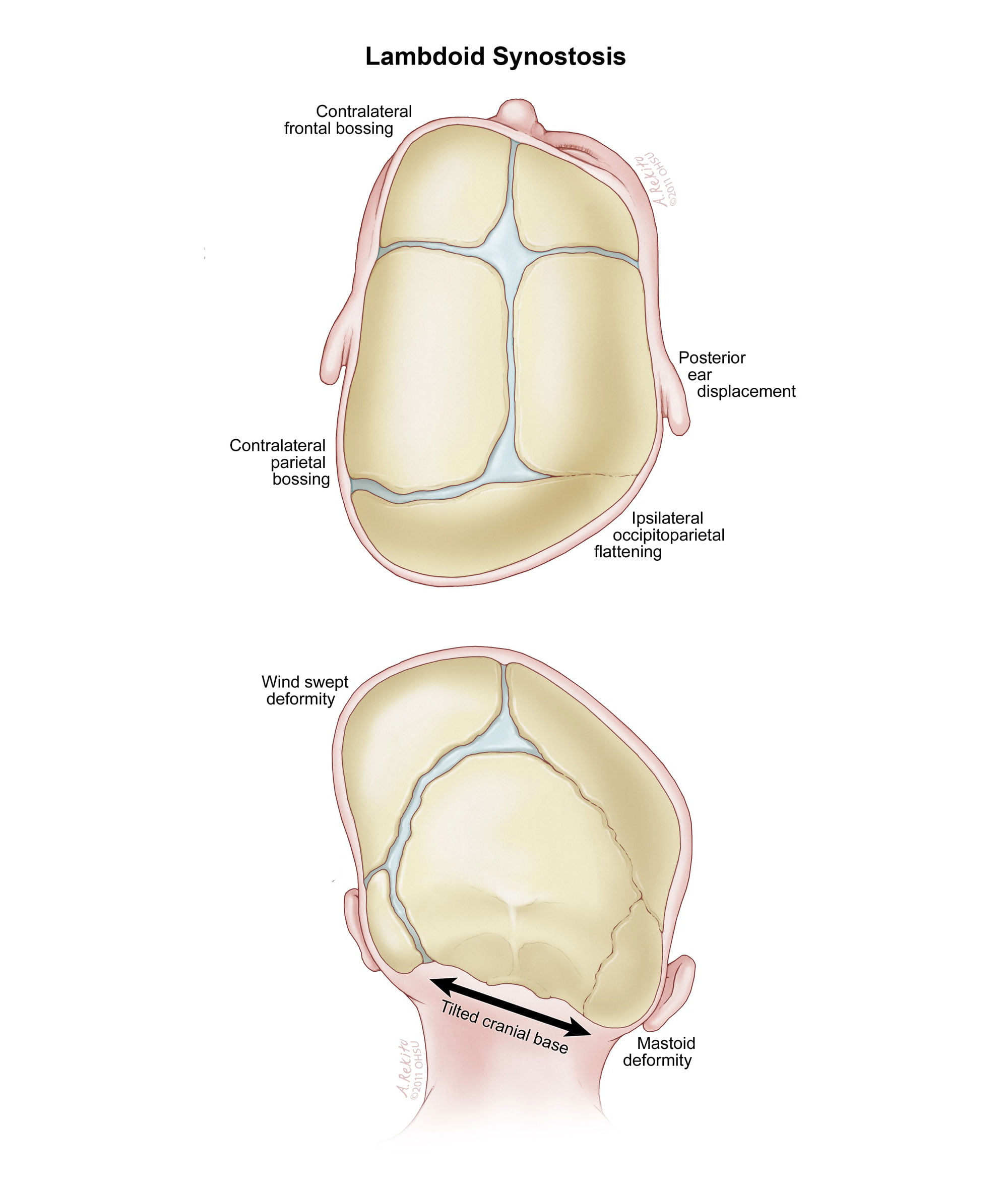 evaluation of positional plagiocephaly in children the ispn guide