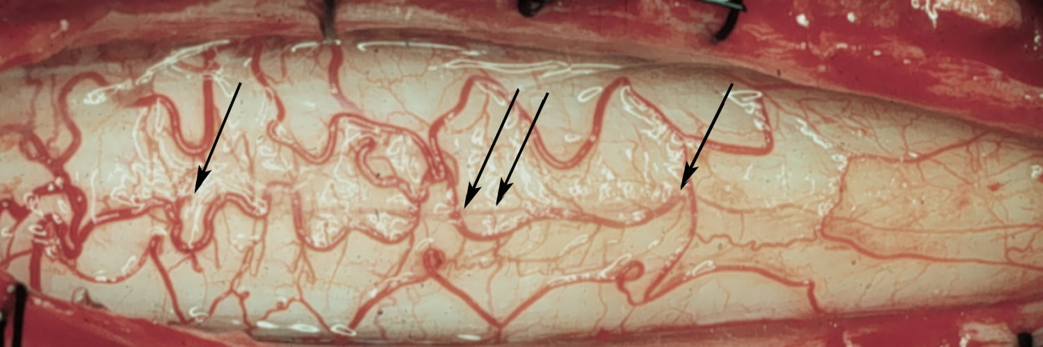 Pial vessels penetrating median raphe
