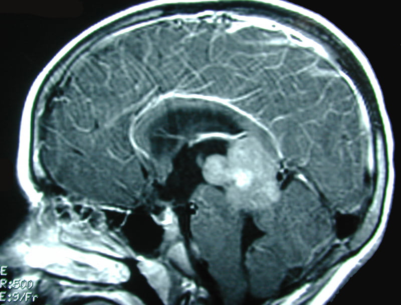 Pineal Region Tumors in Children Homepage - The ISPN Guide to Pediatric