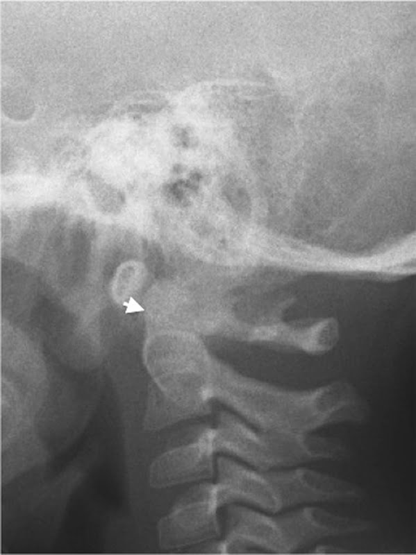 X-Ray of C-Spine in neutral position, lateral view.