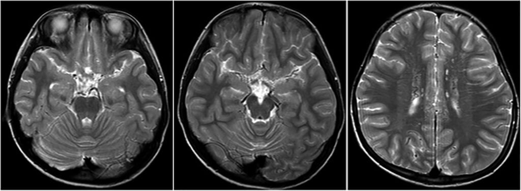 Evaluation of Moyamoya Disease in Children The ISPN