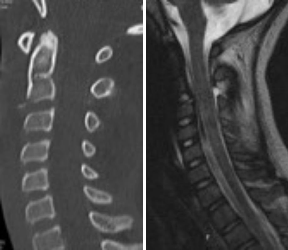 Teardrop fracture of C2