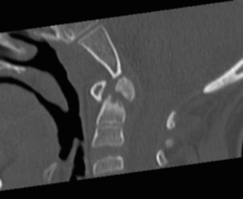 Odontoid Fractrure, Type 1