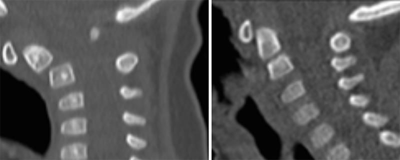 Epiphysiolysis injury of odontoid