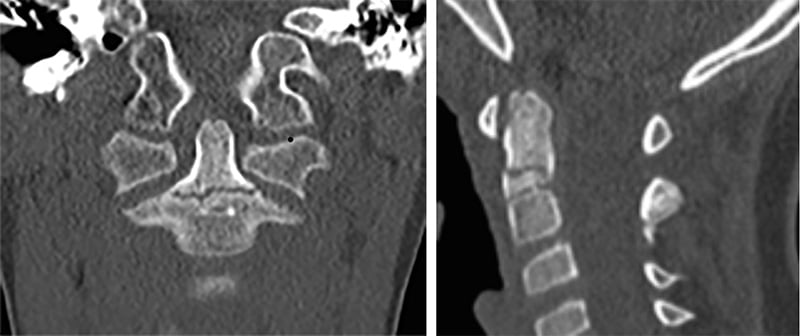 Type II Odontoid Fracture