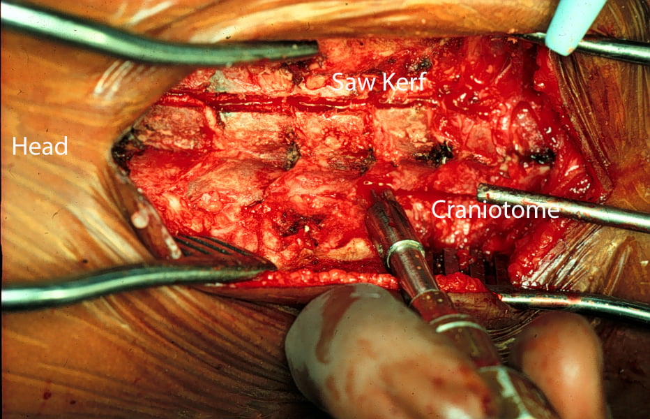 Craniotome performing a multilevel laminotomy.